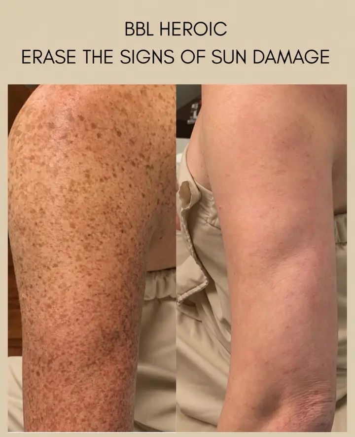 YOUR SKIN REMEMBERS THE SUN. BBL HEROic HELPS REVERSE THE VISIBLE DAMAGE