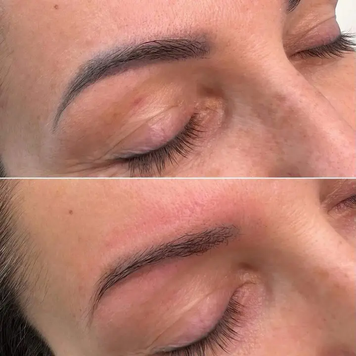 Candela PicoWay Eyebrow Tattoo Removal
