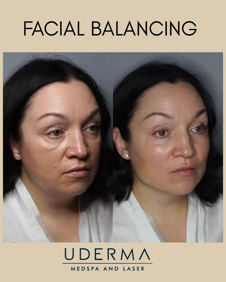 Beautiful example of how facial balancing can create a younger, more lifted