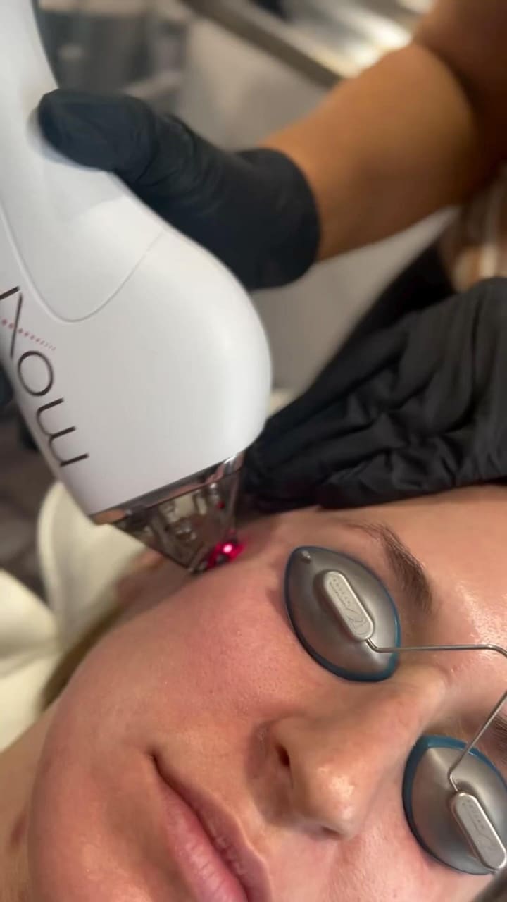 MOXI is a gentle laser which resurfaces skin to help lighten, brighten and refre