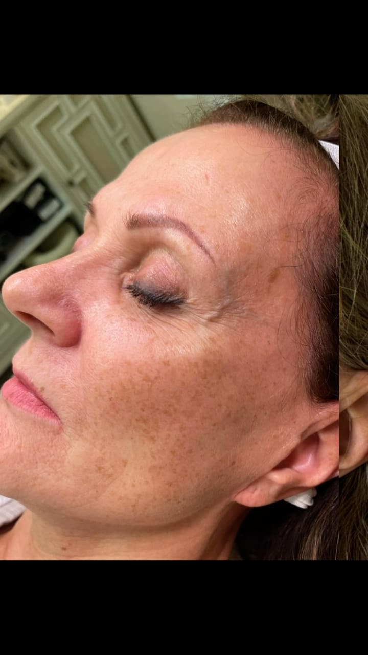 The combination therapy of MOXI and BBL is an unbeatable treatment pairing for t