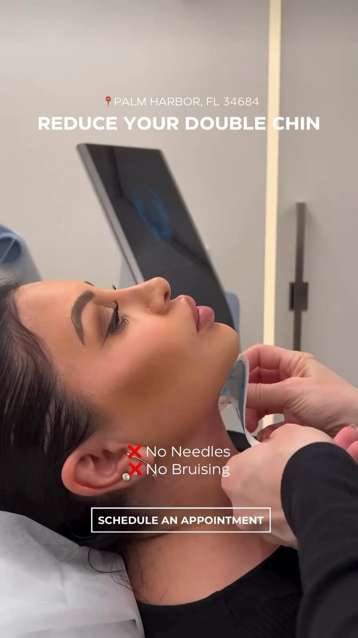 EMFACE Submentum is a non-invasive, double-chin removal that targets both the de