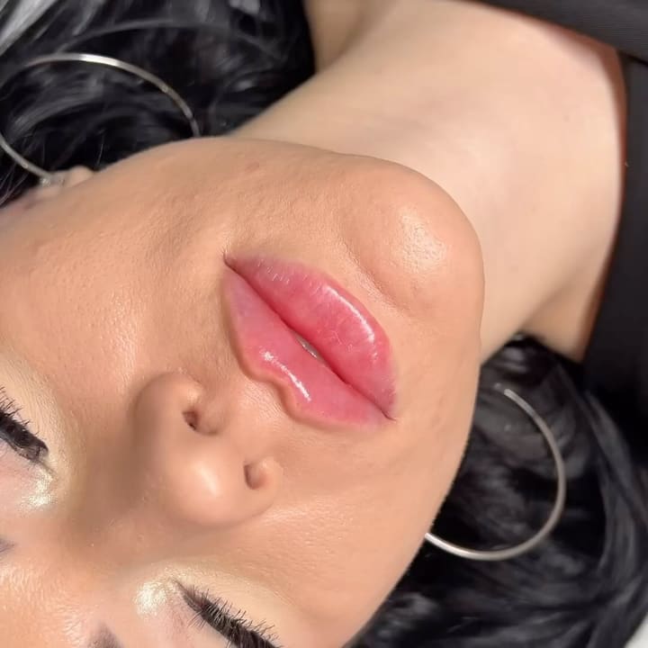 RHA lip filler offers a revolutionary approach to lip enhancement, providing nat