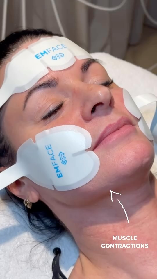 EMFACE is the needle-free procedure that reduces wrinkles and provides more lift