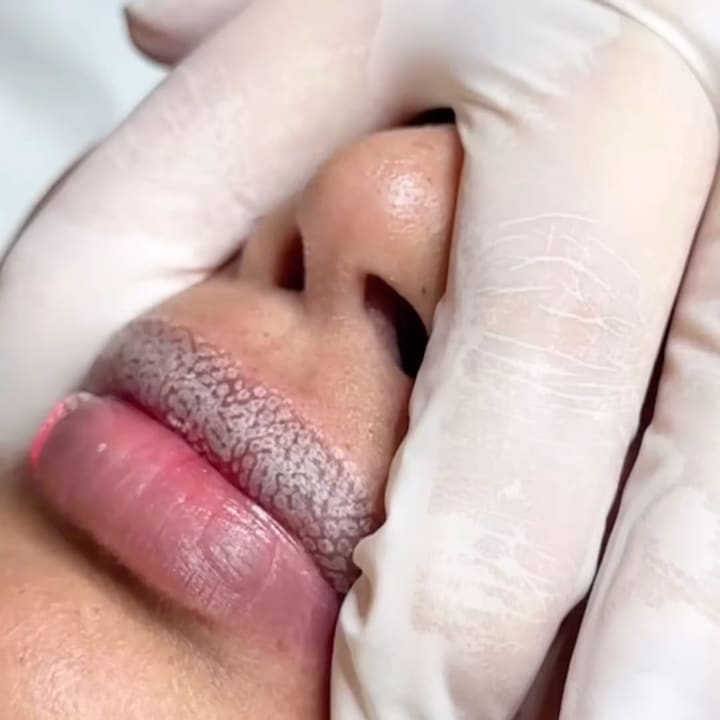 LipLase A non-invasive laser treatment for fuller, smoother, plumper lips!