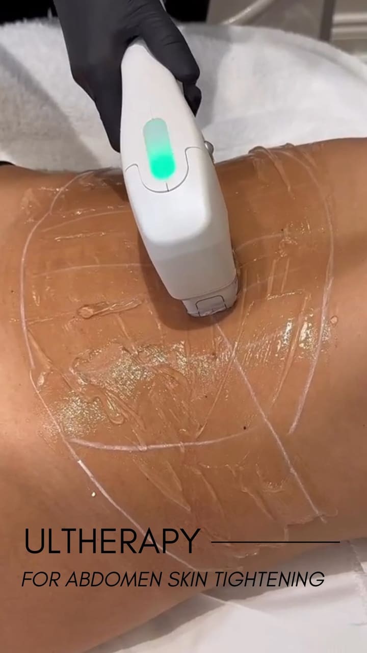 Ultherapy is a popular non-invasive skin tightening and lifting treatment often