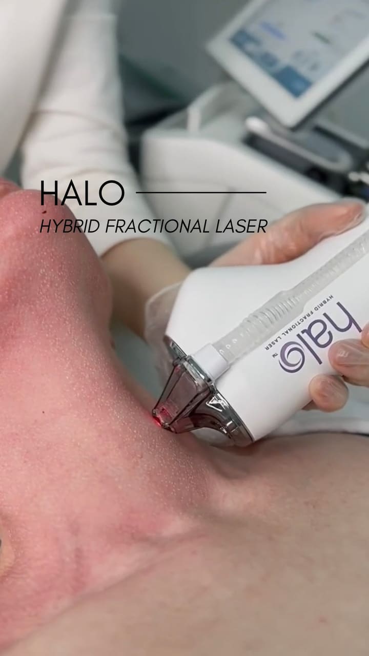 The Halo laser is a hybrid fractional laser treatment that combines both ablativ