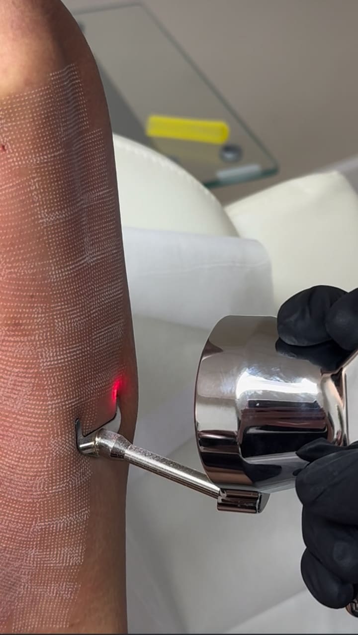Erbium Sciton Laser Skin Tightening is a cosmetic procedure that uses an erbium