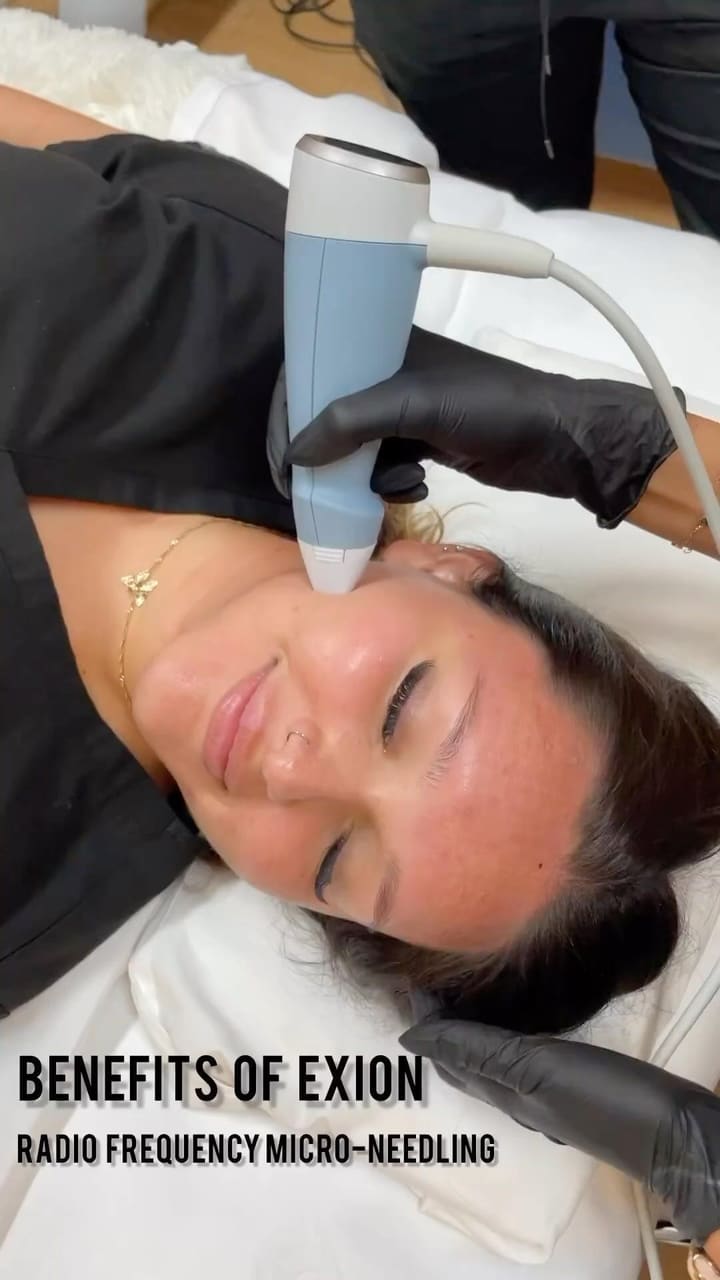 Exion has all the benefits of Targeted Ultrasound Energy combined with Fractiona