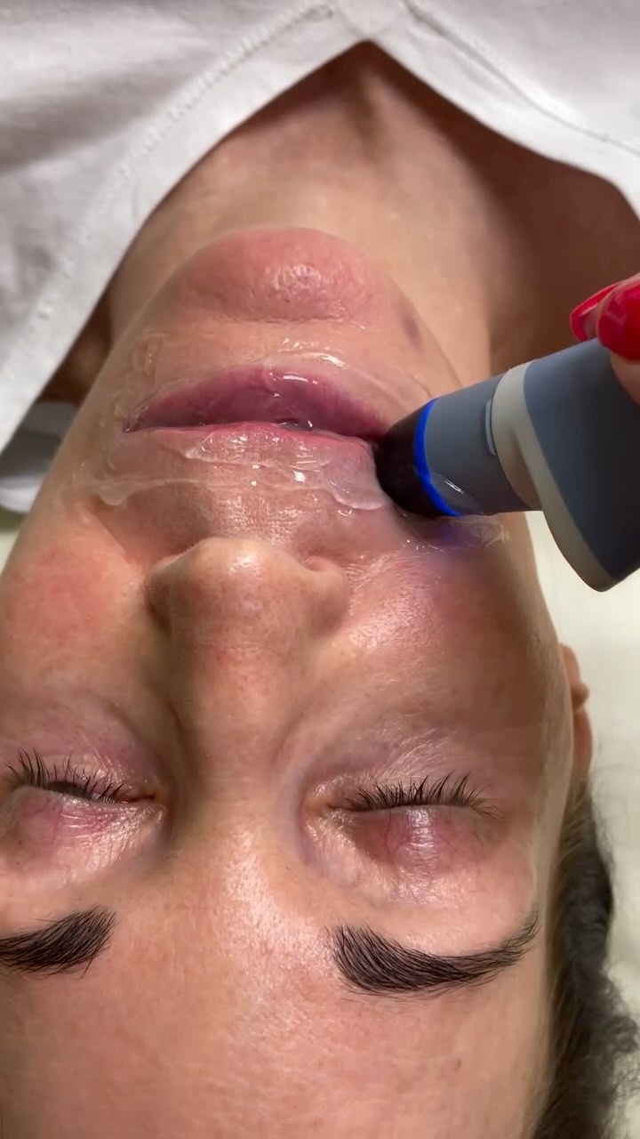 Fuller lips without needles & filler