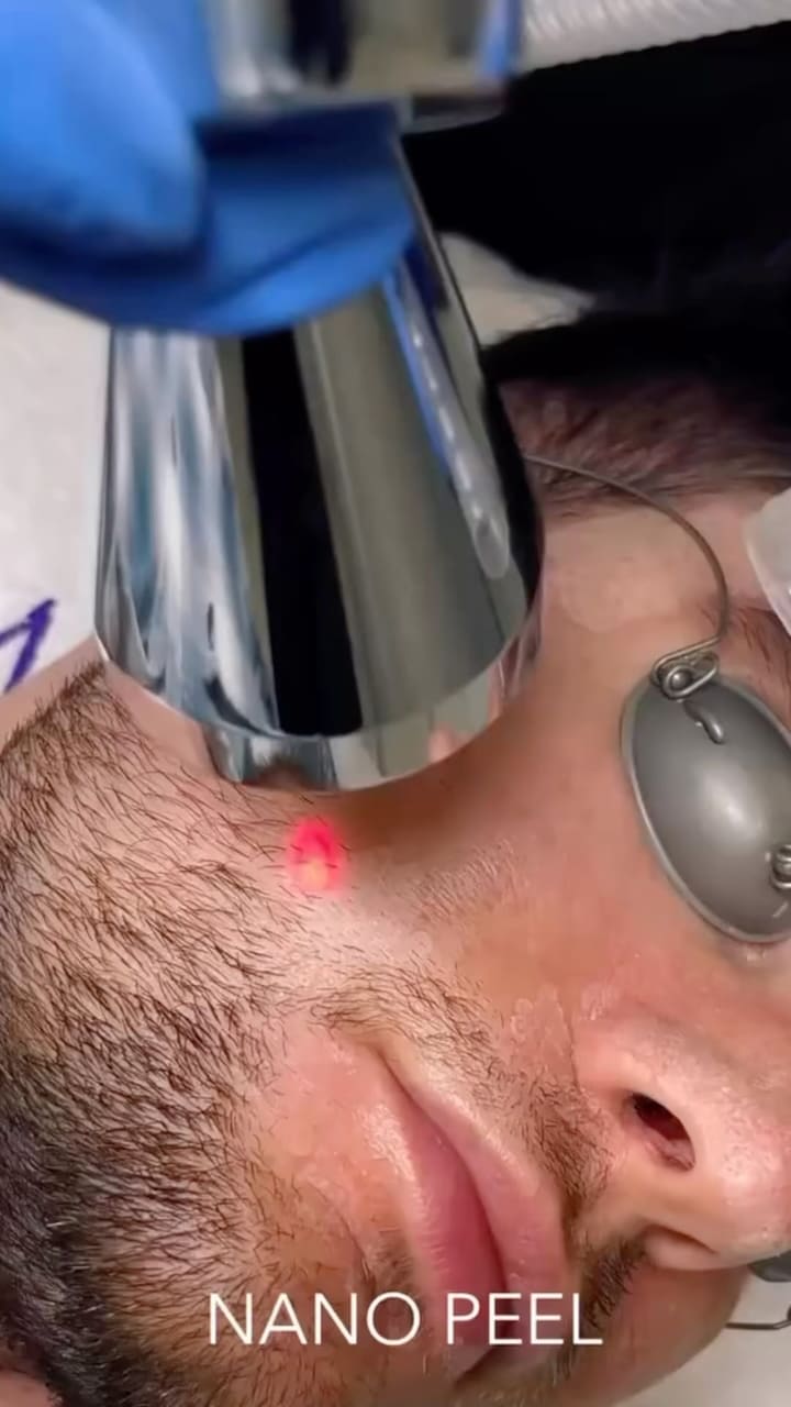 NanoLaserPeel