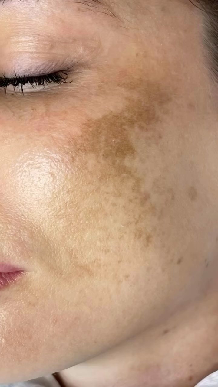 We are offering a comprehensive treatment for melasma that combines BBL (BroadBa