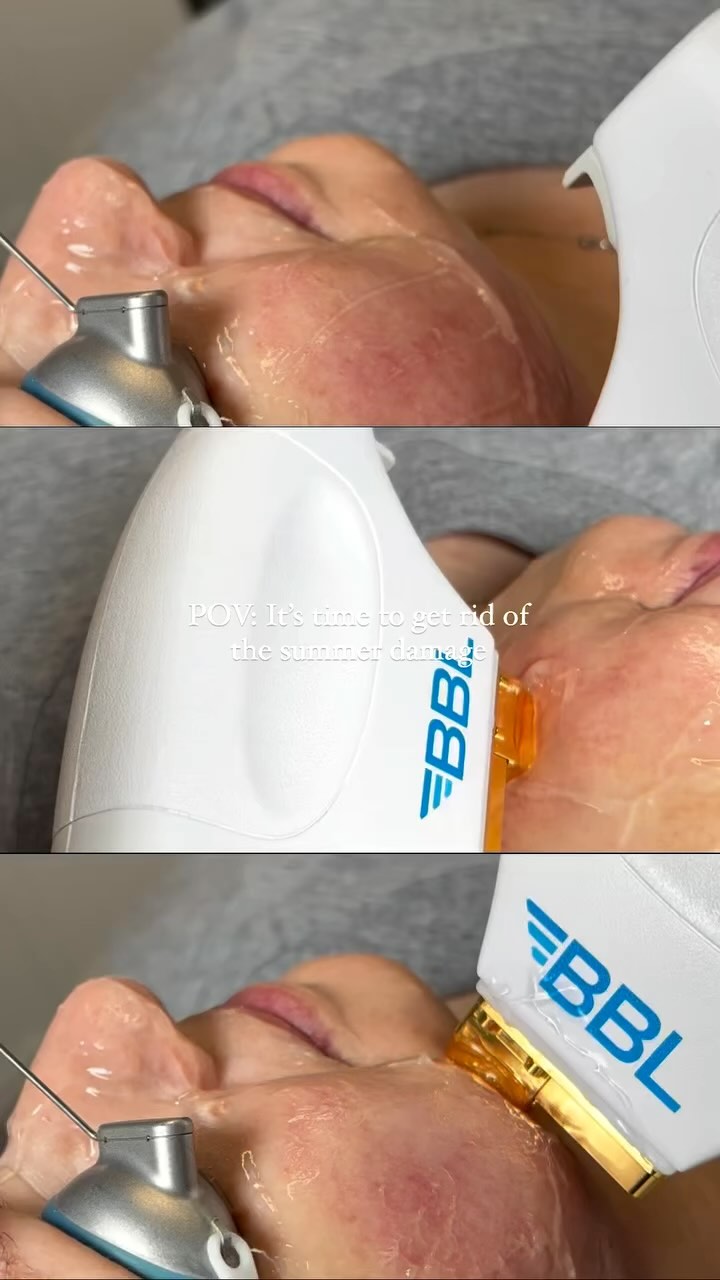 Reveal Your Best Skin with BBL HERO