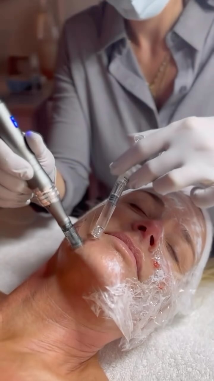 Exosome Microneedling