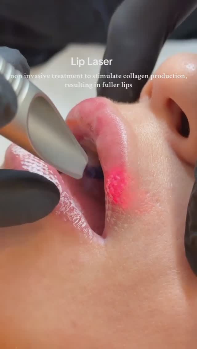 Smooth, Soft, and Youthful Lips with Laser Rejuvenation