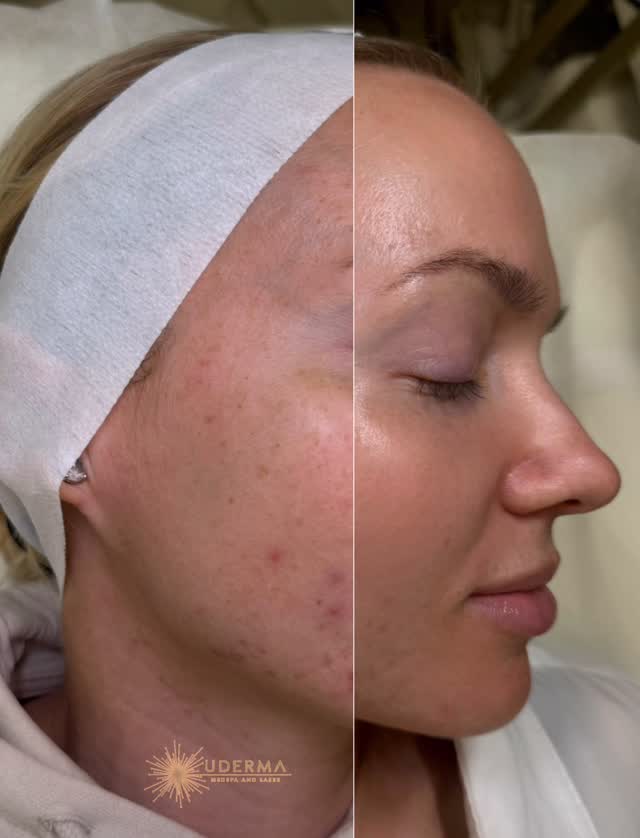 Reveal Your Glow with BBL + Moxi