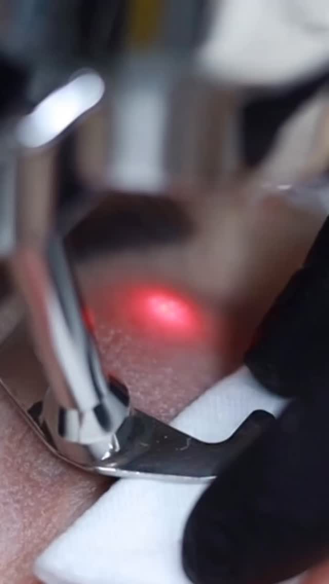 ProFractional Erbium Laser
