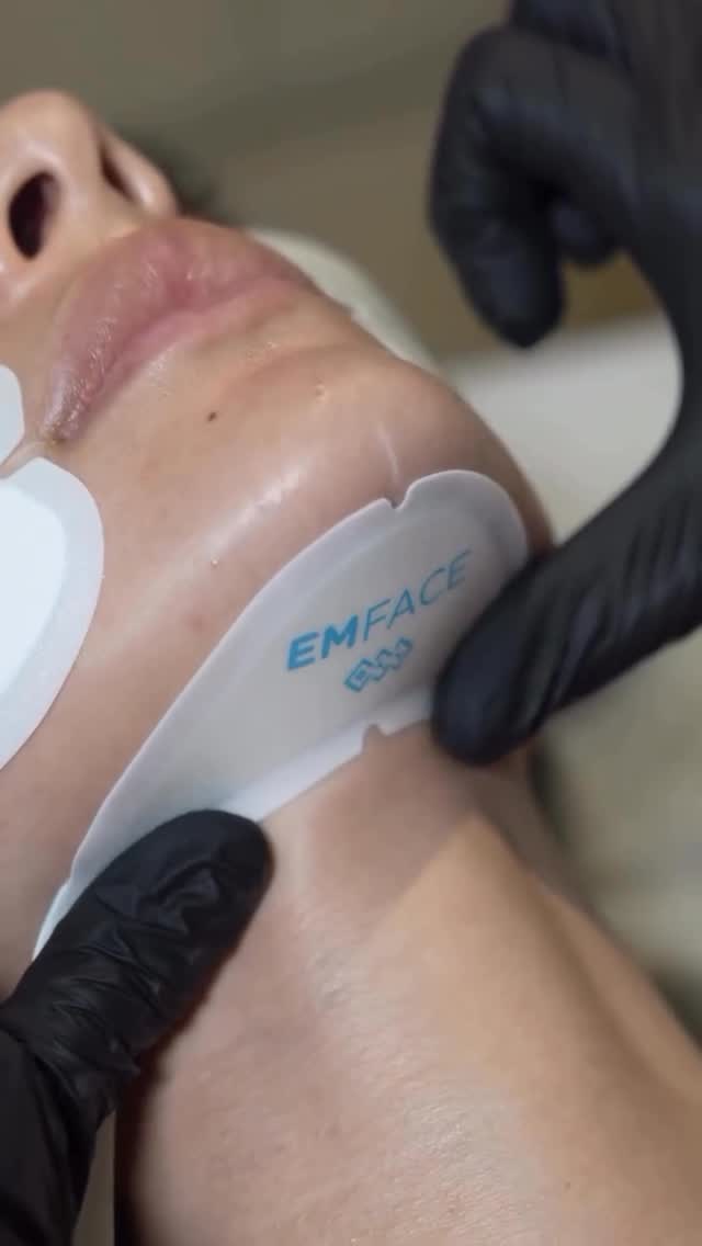 EMFACE® — a unique, non-invasive procedure for facial lifting, skin tightening,