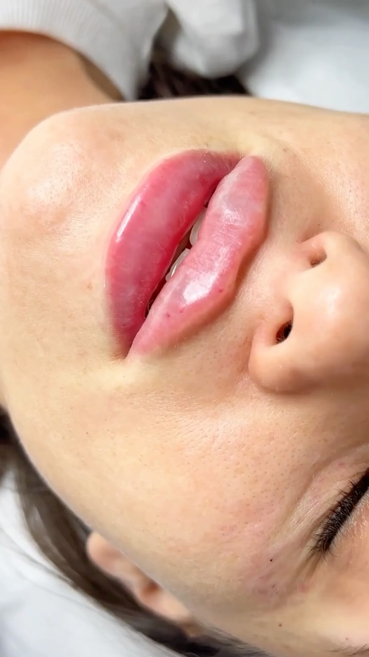 LIP FILLER — Enhance Your Anatomy, Not Change It At UDERMA, we believe in natura