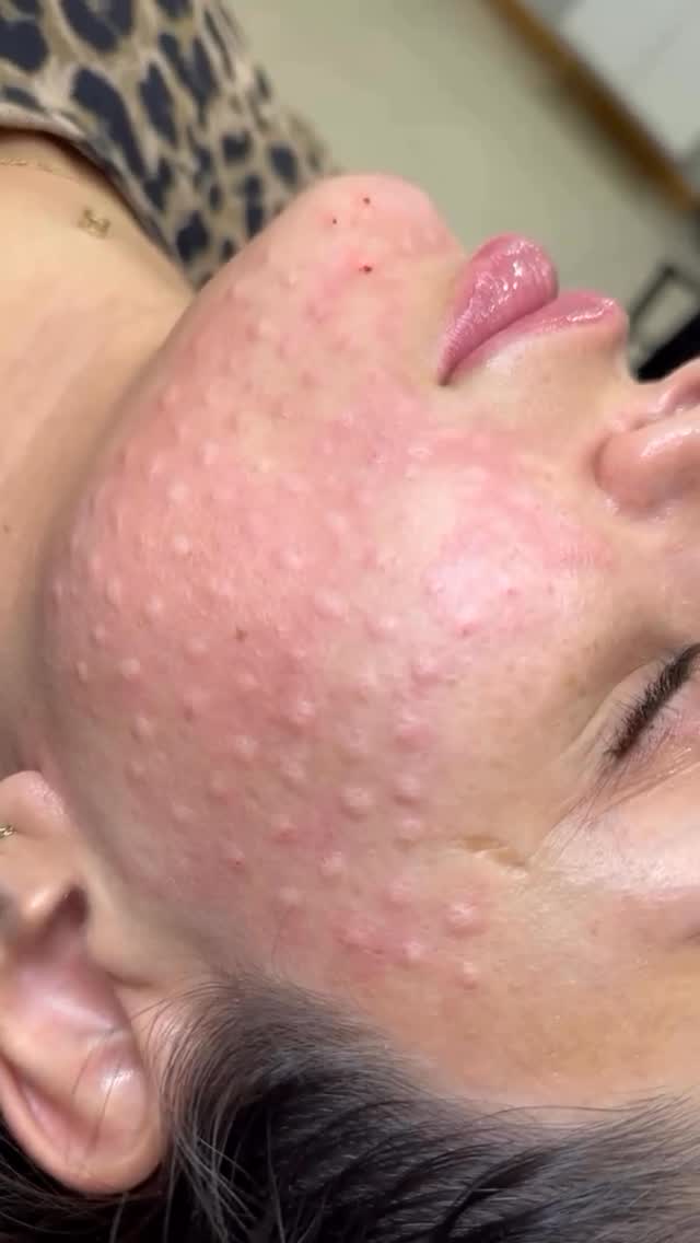 Not all skin treatments are about filling or tightening