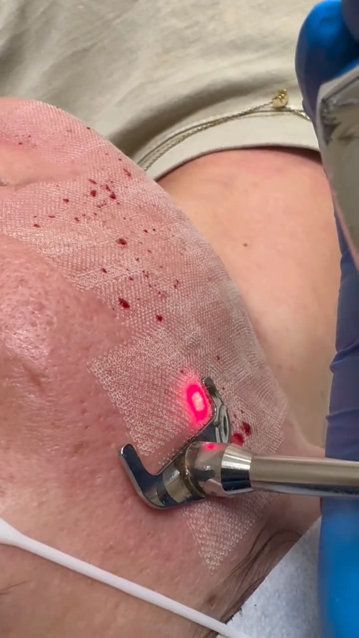 ProFractional Laser is an advanced ablative resurfacing treatment that creates c