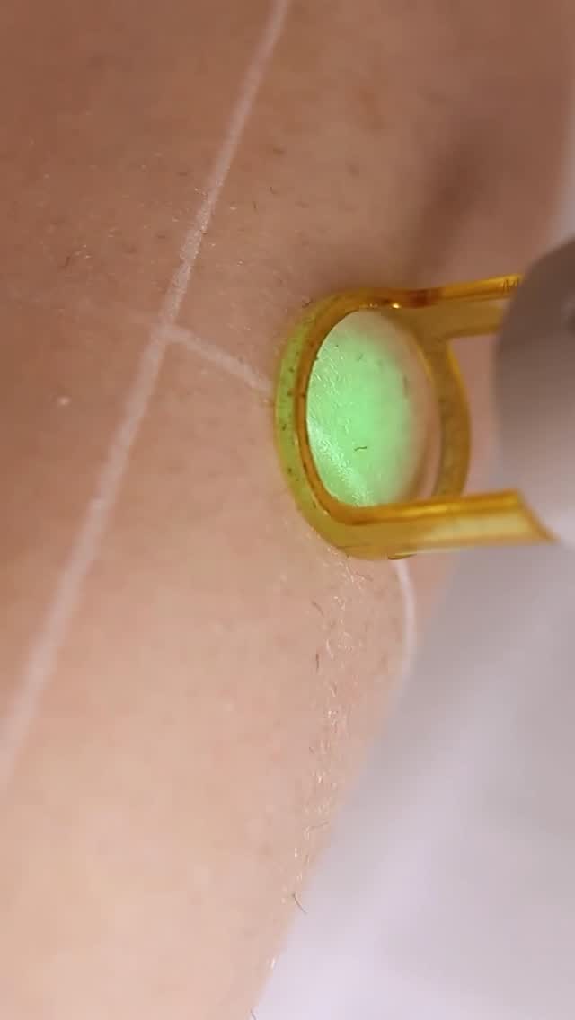 Laser Hair Removal with Candela GentleMax Pro