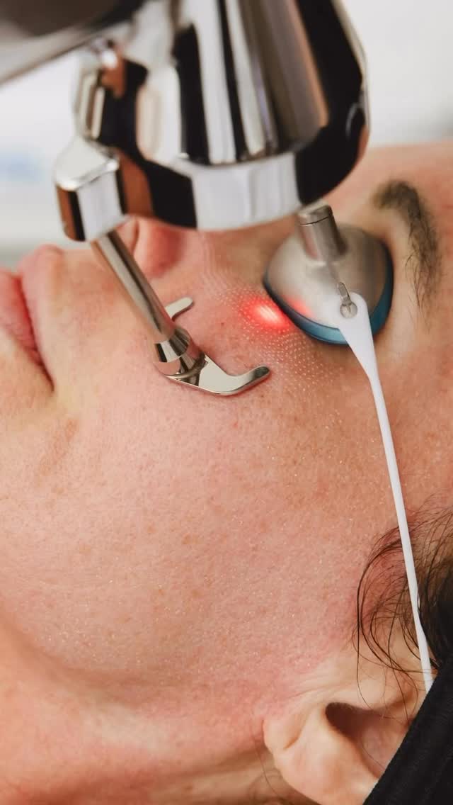 ProFractional laser is similar to CO₂