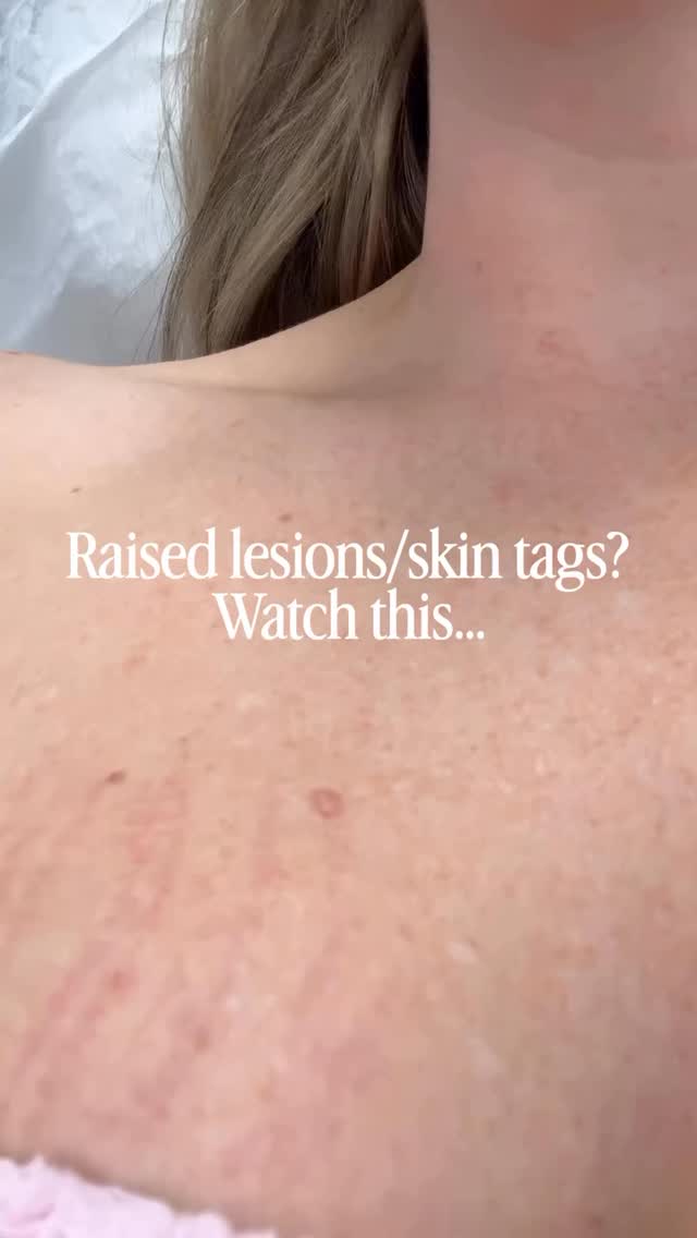 Raised lesions or skin tags