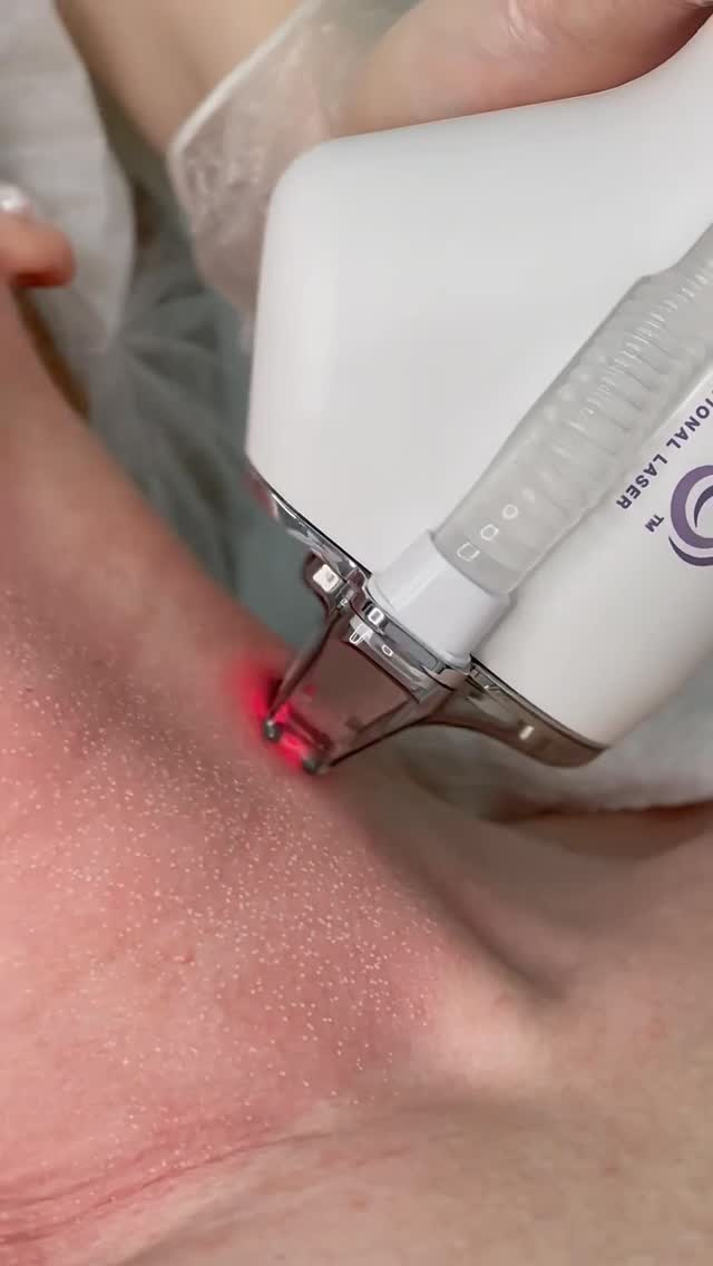 Halo® Laser Resurfacing