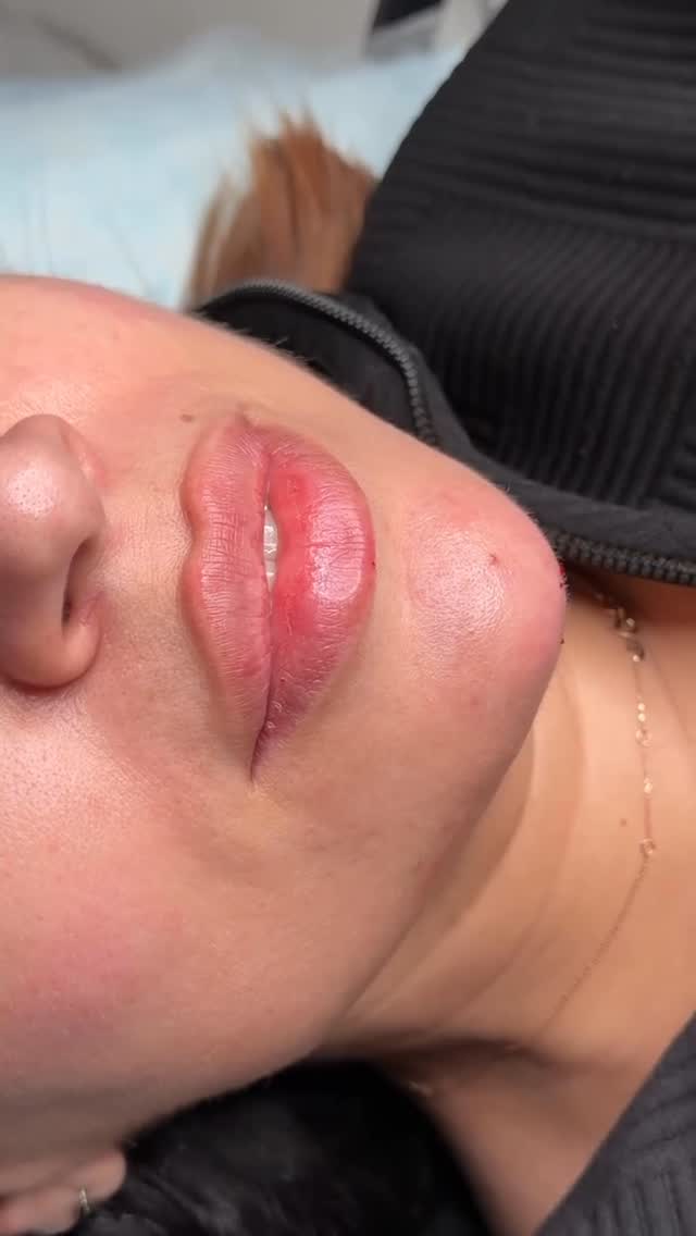 Lip + Chin Filler = The Perfect Balance