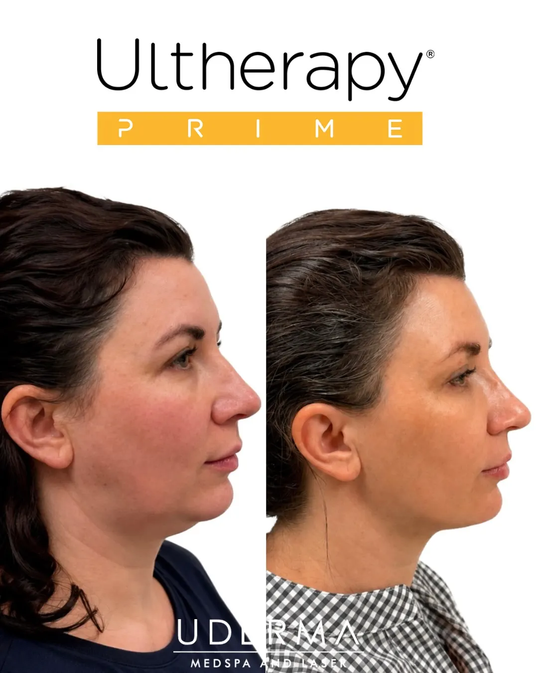 4-Month Ultherapy Prime Transformation ✨