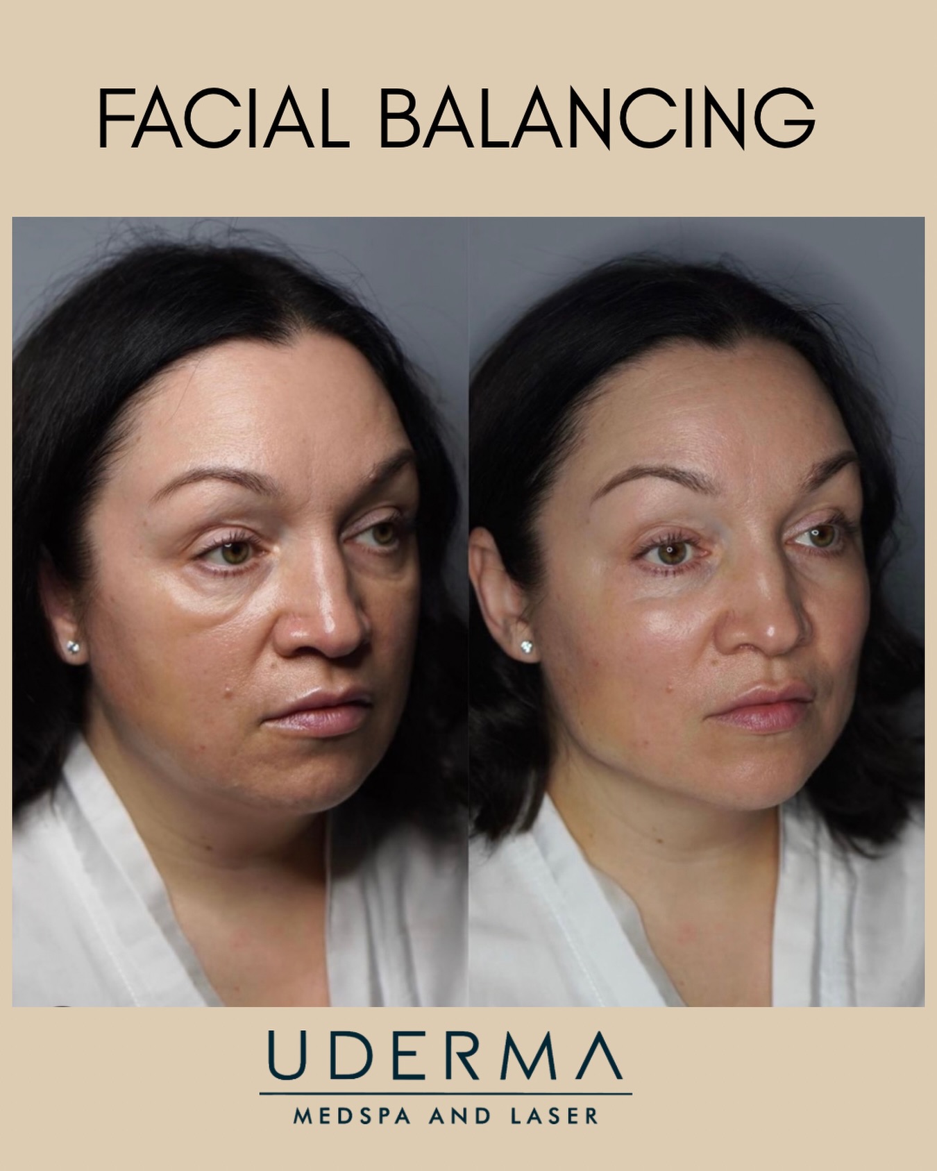 Beautiful example of how facial balancing can create a younger, more lifted, refreshed appearance — all in just one trea