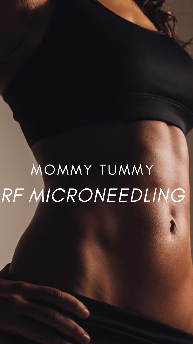 RF Microneedling for Mommy Tummy🤍