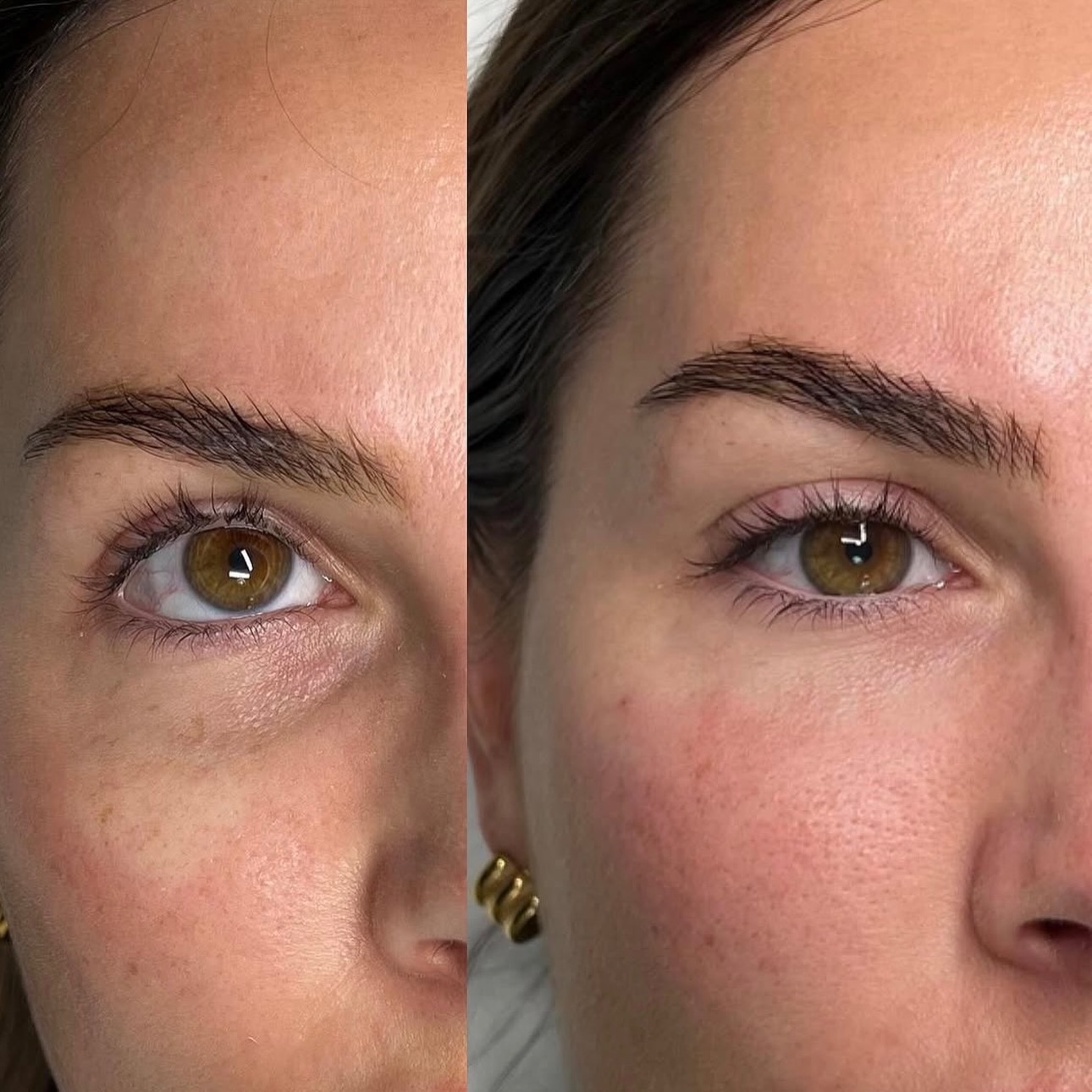 For under-eye darkness and hollowness, every case is different and requires an individual assessment.