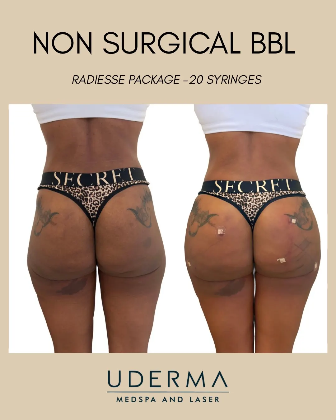 ✨ NON-SURGICAL BBL WITH RADIESSE ✨