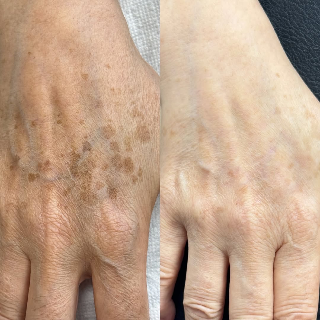 When you book your BBL HEROic + MOXI face treatment, you can add an additional area starting at only $250 — and the diff