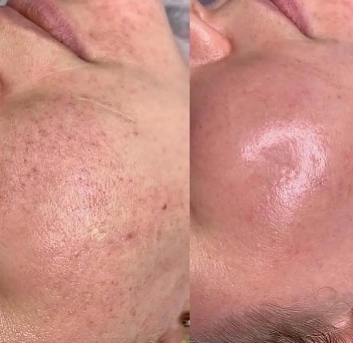 Laser Nano Peel (erbium superficial laser) is a quick, no-numbing treatment with zero to minimal downtime. It leaves you