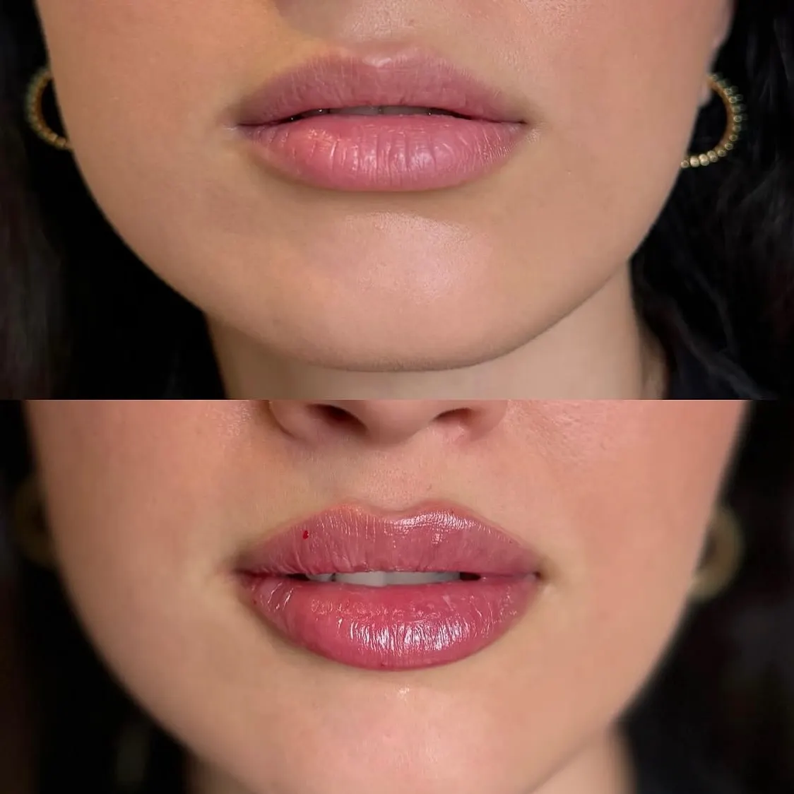 Beautiful lips don’t have to look overdone. This transformation enhances shape, symmetry, and hydration while keeping a 